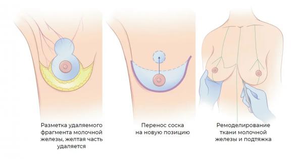 Редукционная маммопластика: как проводится операция по уменьшению груди. Операция по уменьшению груди
