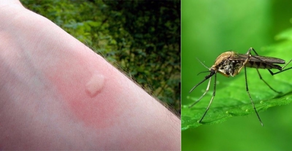 Чем обработать место укуса комара, чтобы снять зуд