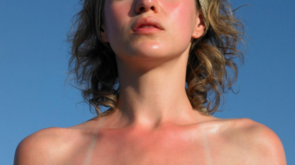 Бывает ли аллергия на солнце: мифы факты и способы лечения