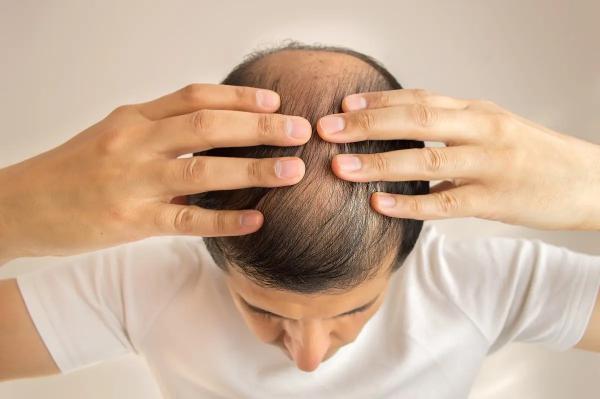 5 основных причин выпадения волос у мужчин и как с ними бороться: советы экспертов. Причины выпадения волос у мужчин